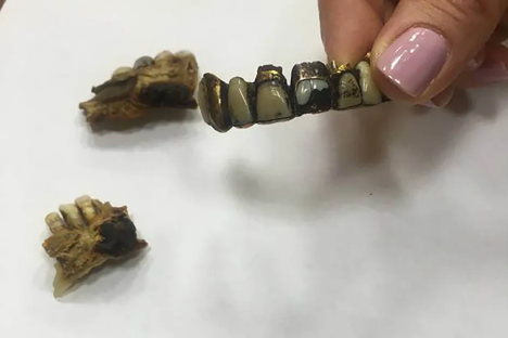 Gold-inlaid teeth.