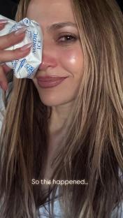 Jennifer Lopez with an ice pack on her eye.