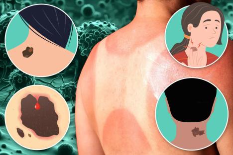 The terrifyingly few times you need to have suffered sunburn to ‘double risk of killer melanoma’ – plus 5 signs to spot