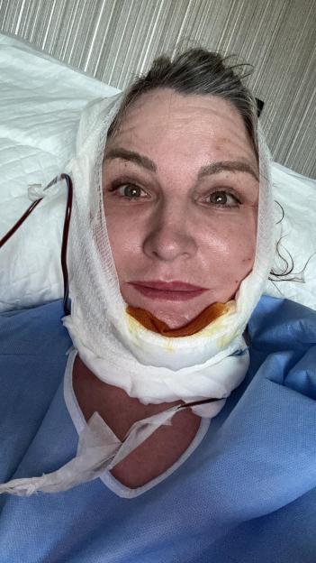Woman with bandages and tubes around her face and neck after a face and neck lift.