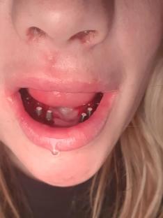 Close-up of a woman's mouth with bleeding gums and visible implants after a botched dental procedure.