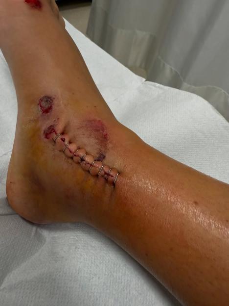 Close-up of a stitched ankle wound.