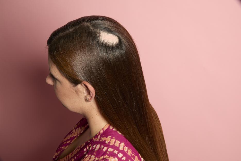 Side profile of Charlotte Dodds showing a patch of hair loss on her head.