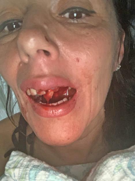 Close-up of a woman's bloody mouth and injured jaw after an assault.