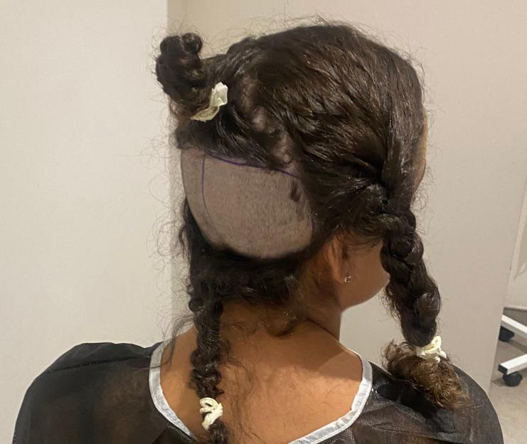 Shaved head of a person with hair in braids, showing donor area for hair transplant.