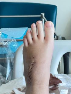 Foot with surgical scar.