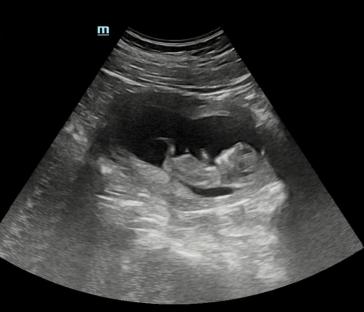 Ultrasound image of a fetus.