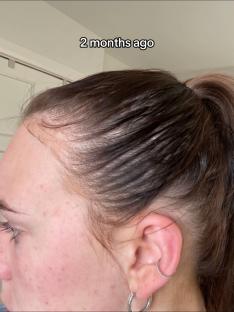 Close-up of a person's hair tied in a ponytail, showing their hairline two months prior.