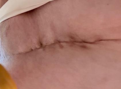 Scar from tummy tuck surgery.