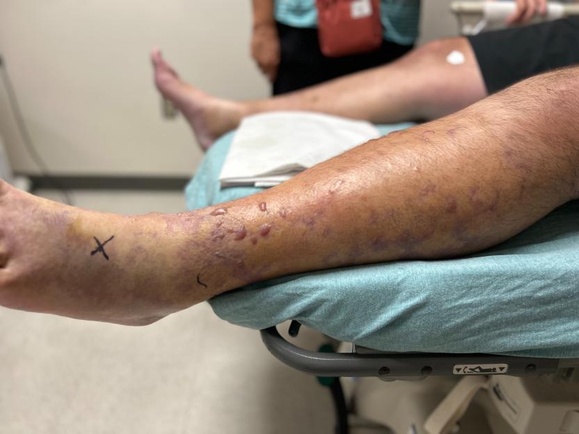 Close-up photo of a leg with flesh-eating bacteria infection.