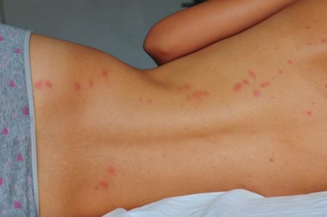 Person's back with multiple insect bites.