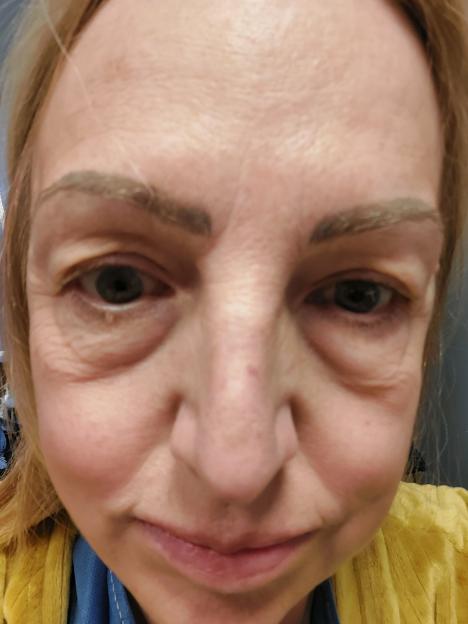 I Transformed My Look with £7.8k Eyelid Surgery After a Shocking Bus Pass Photo – Now I Look a Decade Younger!
