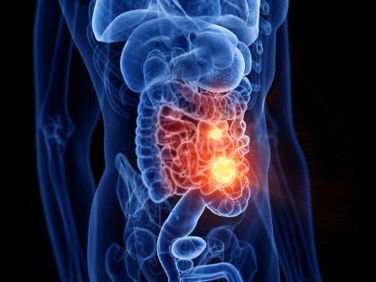 Illustration of small intestine cancer.