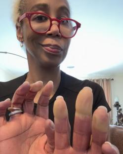 Close-up of Trisha Goddard's hands showing discoloration on her fingers.
