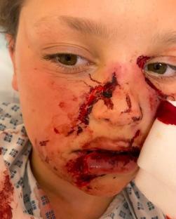 Close-up photo of a child's severely injured face after a dog attack.