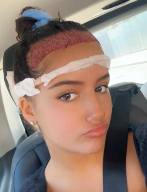Teenage girl after hair transplant surgery.