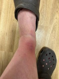 Swollen and bruised ankle after spider bite.