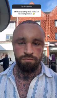 Man with swollen head after hair transplant.