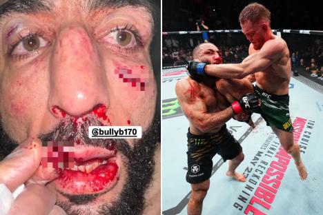 Former UFC champion’s lip RIPPED apart as Dana White shares gruesome picture of star’s injuries after bloody defeat