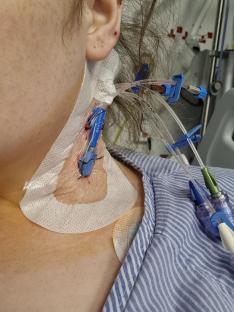 Close-up of a woman's neck with a cannula inserted.