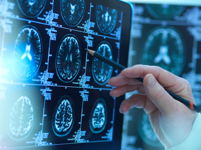 Huntington’s disease ‘slowed for first time’ with ground-breaking gene treatment