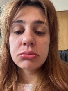 Close-up of a woman's face showing skin irritation.