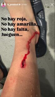 Bloody leg wound.