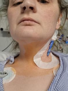 Close-up of a woman's neck with a cannula inserted.