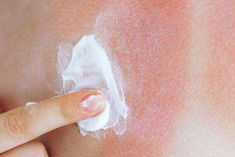 Sunburned skin with cream being applied.