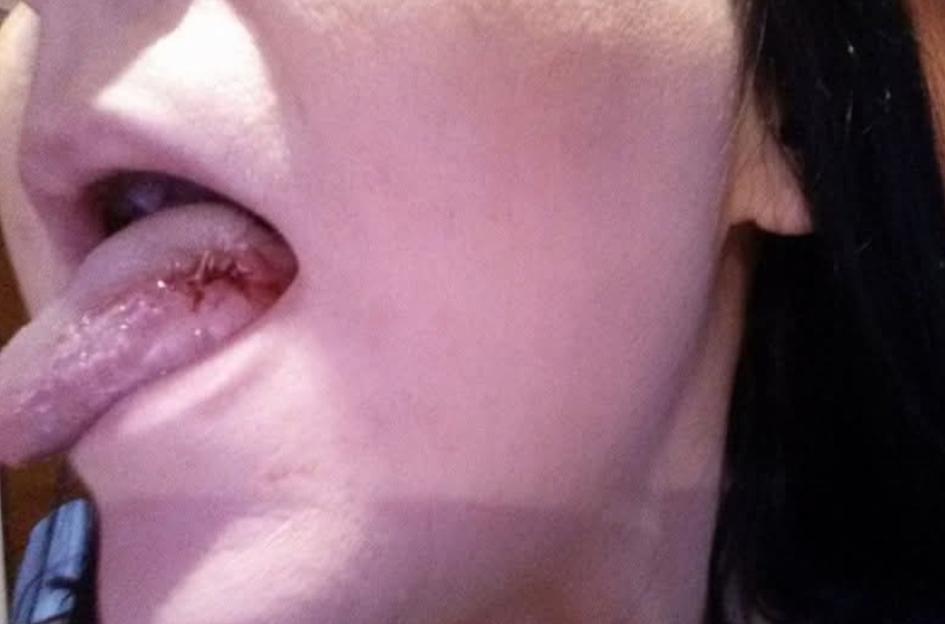 Close-up of a woman's tongue showing a surgical scar.
