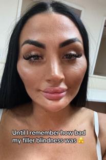 Close-up selfie of a woman with noticeable facial fillers, captioned