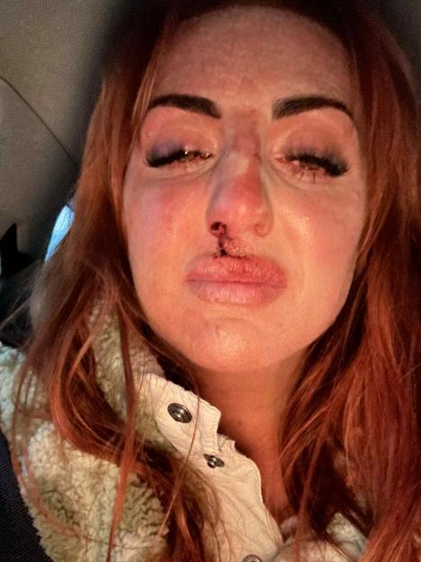 A woman with a bruised nose and swollen face.