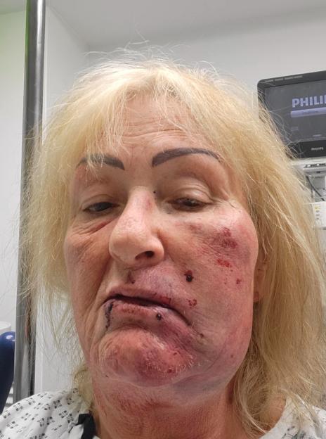 Close-up of a woman's face showing significant bruising and cuts.