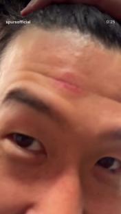 Close-up of a person's forehead showing a scar.