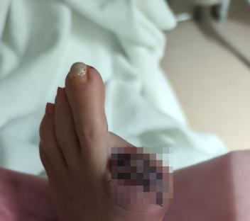 Close-up photo of a woman's foot with a bandaged big toe after amputation.