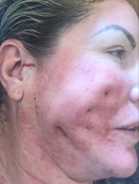 A woman's face with visible skin damage and scars from a botched thread lift surgery.