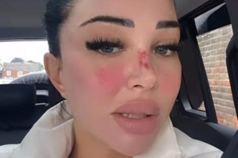 Tulisa shows off bloodied nose as she reveals SIX painful beauty procedures that keep her ‘eyebrows and cheeks’ pert