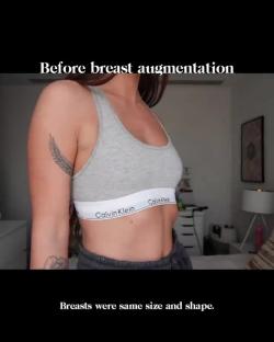 Pre-breast augmentation photo showing breasts of the same size and shape.