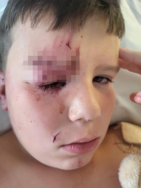 Close-up of a child's injured face.