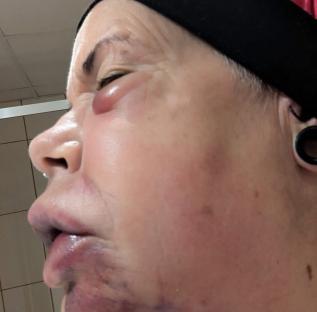 Close-up profile view of a person's face showing significant bruising and swelling.