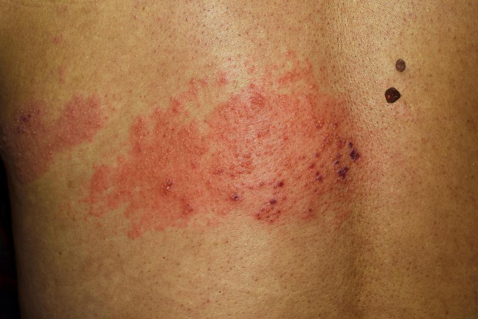 Shingles rash on a person's back.