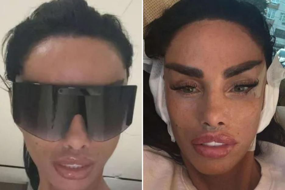 Katie Price reveals new face and admits she ‘can’t SMILE’ after getting MORE surgery in Turkey