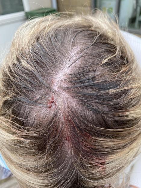 Photo of a woman's head wound after a seagull attack.