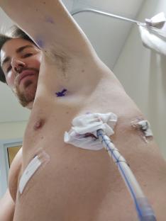 Man's chest with medical bandages and a chest tube.