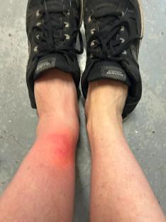 Swollen and reddened ankle from a spider bite.