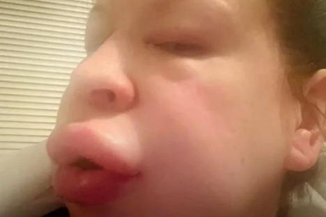 Mum’s face ‘blew up’ and painful red blisters engulfed her whole body after she spotted black mould spores in her home