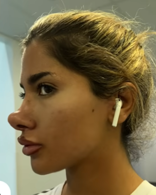A woman with a surgically altered "pixie" nose.
