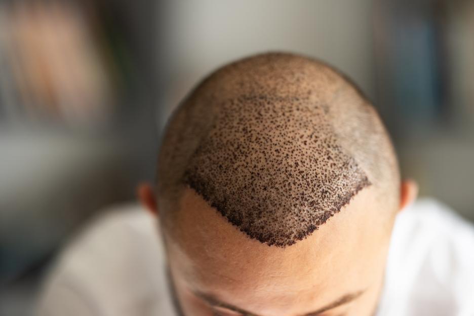 Top view of a man's scalp after a hair transplant.