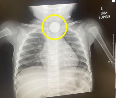 X-ray showing a button battery lodged in a child's throat.