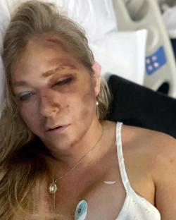 Virginia Giuffre in hospital bed with facial injuries.